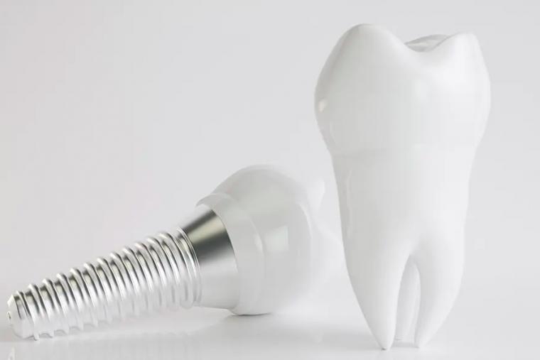インプラントのオールオン4と総入れ歯の特徴と費用を徹底比較