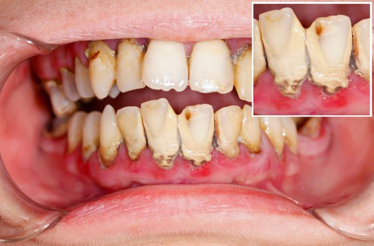 歯がボロボロでも治療できる？原因・治し方・費用まで徹底解説