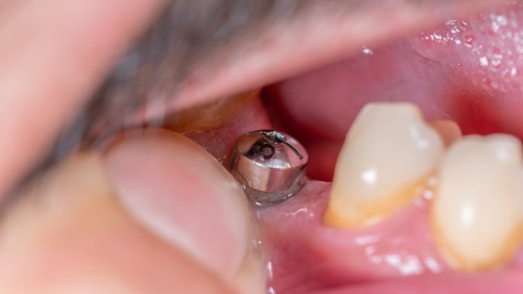 奥歯のインプラントは必要？放置するリスクと治療を選ぶ判断基準