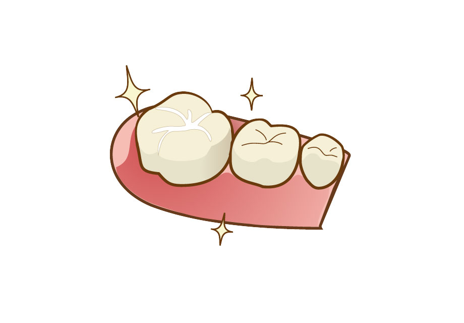シーラント（保険適用）