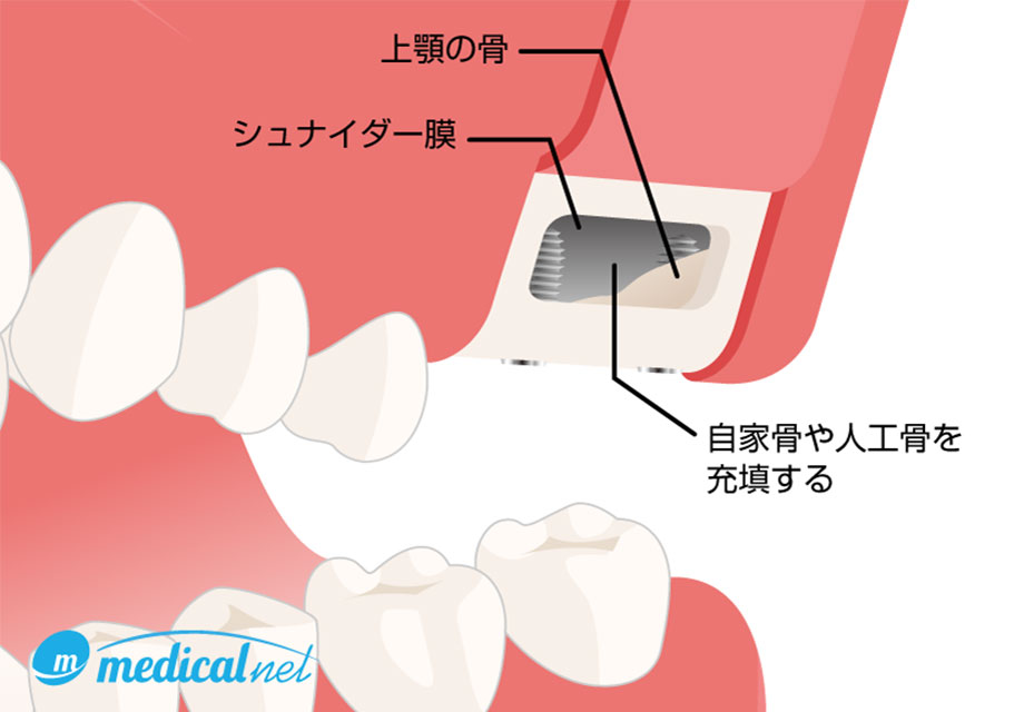 サイナスリフト